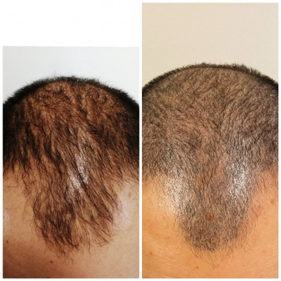 foto tricopigmentazione prima e  dopo circa 2 mesi dall'ultima seduta