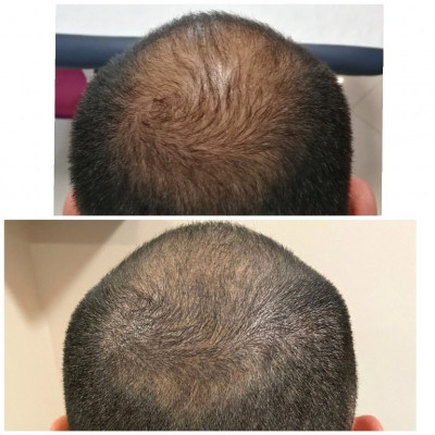 foto tricopigmentazione prima e dopo circa 2 mesi dall'ultima seduta