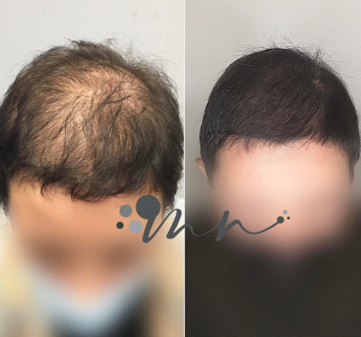 Alopecia Femminile scala di Ludwig