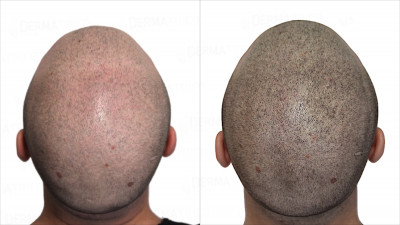 Tricopigmentazione prima e dopo