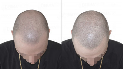 Tricopigmentazione effetto rasato prima e dopo