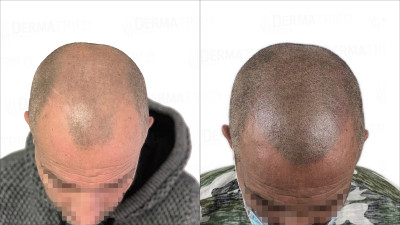Tricopigmentazione effetto rasato prima e dopo.