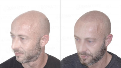 Tricopigmentazione effetto rasato Prima e Dopo