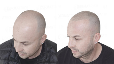 Tricopigmentazione effetto rasato - Prima e Dopo.