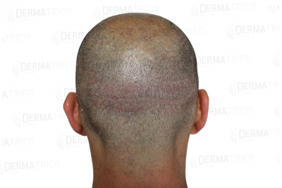 tricopigmentazione-scar-cicatrice-effetto-rasato-7b.png
