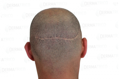 tricopigmentazione-scar-cicatrice-effetto-rasato-7a.png