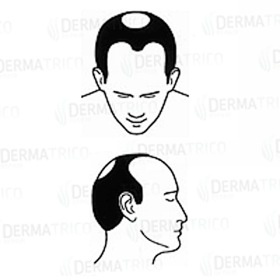 Diradamento-Temporale-Vertex-costi-Tricopigmentazione.png