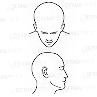 Diradamento-Alopecia-universale-costi-Tricopigmentazione.png