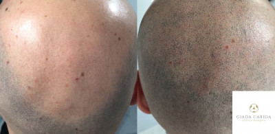 Tricopigmentazione effetto rasato Pre e Post