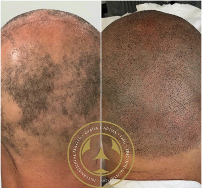 Tricopigmentazione effetto rasato su alopecia areata