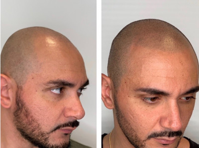 Tricopigmentazione Pre e Post