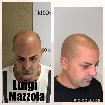 Tricopigmentazione effetto rasato Pre e Post