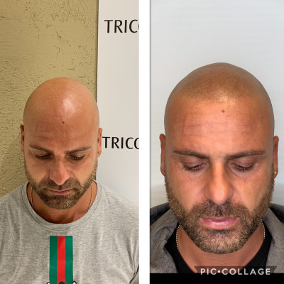 Tricopigmentazione effetto rasato Pre e Post