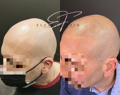 Tricopigmentazione effetto rasato Pre e Post