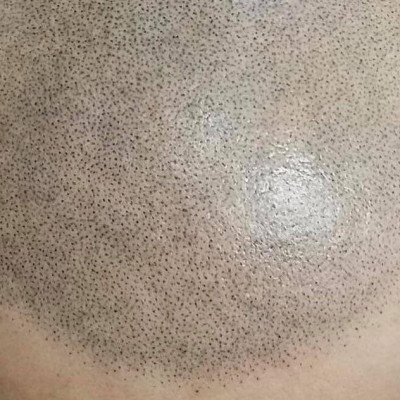Tricopigmentazione effetto rasato con derma guarito
