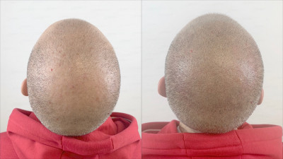 Tricopigmentazione effetto rasato vertex prima e dopo