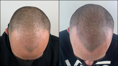 Tricopigmentazione effetto rasato prima e dopo
